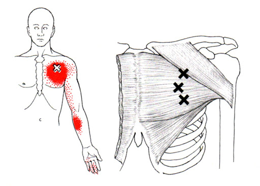 trigger chest - Trainerize.me