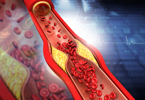 cholesterol